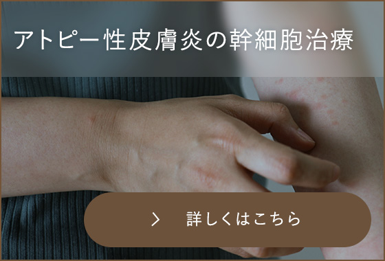 アトピー性皮膚炎の幹細胞治療