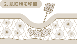 2.肌細胞を移植