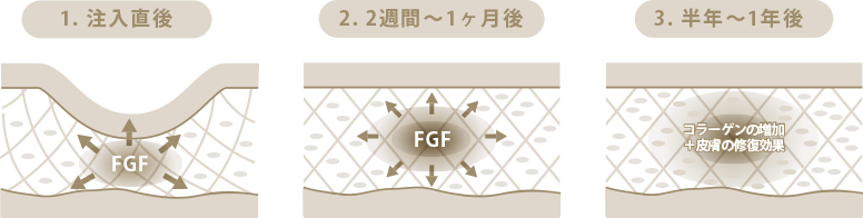 注入直後　2週間〜1ヶ月後　半年〜1年後