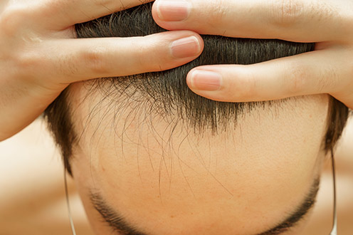 男性の薄毛・抜け毛について