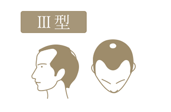 3型