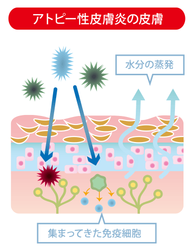 アトピー性皮膚炎の皮膚