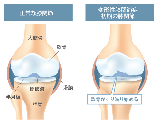 変形性膝関節症の病態