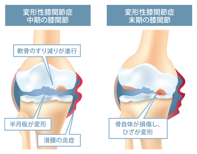 変形性膝関節症の病態