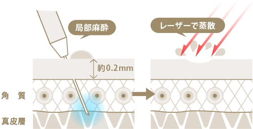 炭酸ガス（CO2）レーザーの治療法