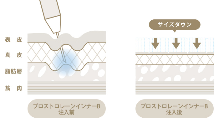 手術を行わず注射だけで、脂肪に働きかけ、部分痩身治療として人気の「脂肪溶解注射」