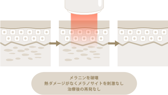 スペクトラの治療法
