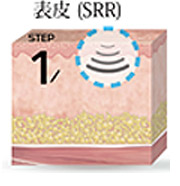 イントラセル（SRR）