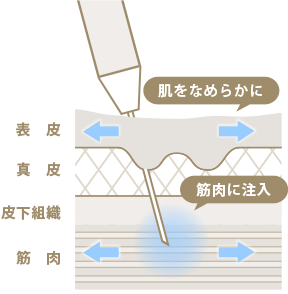 ボツリヌストキシン注射