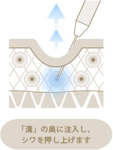 ヒアルロン酸注入