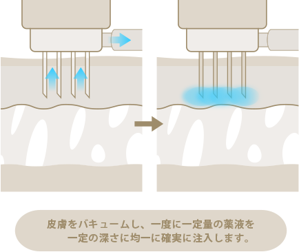 水光注射